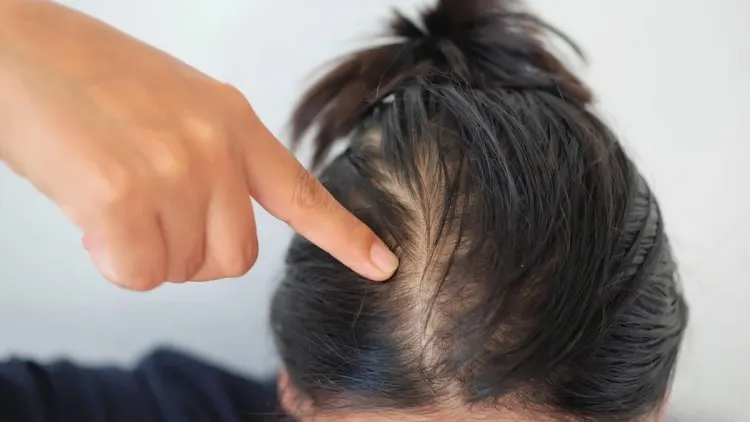 hair fall at young age 