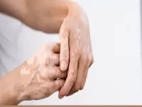 vitiligo in hindi 
