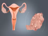 pcos polycystic ovary symptoms 