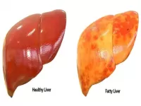 fatty liver in india 