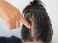 hair fall at young age 