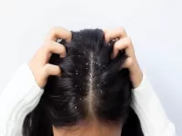 dandruff causes home remedies tips 