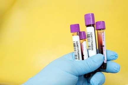 Neonatal Hemoglobin Electrophoresis