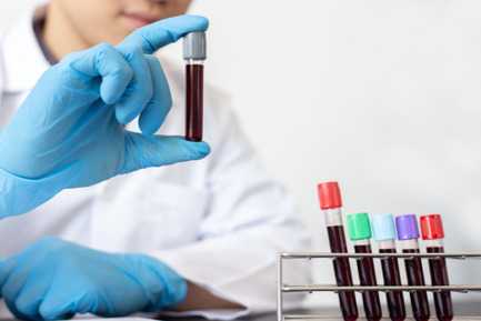 Hepatitis C Virus (HCV) Quantitative Pcr