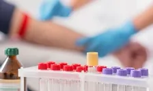 ANTI NUCLEAR ANTIBODIES (ANA)