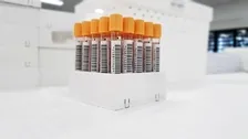 ANTI HEPATITIS B CORE ANTIGEN (AHBC) - TOTAL