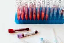 ANTI MICROSOMAL ANTIBODY (AMA)