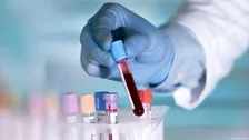 ANTI STREPTOLYSIN - O (ASO)