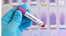 BETA-THALASSEMIA SCREENING