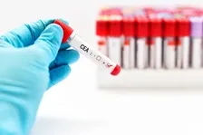 CARCINO EMBRYONIC ANTIGEN (CEA)