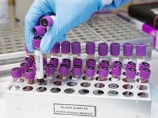 CARDIOLIPIN ANTIBODY (ACL) - IgA 