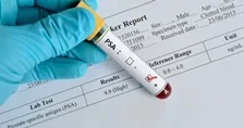 PROSTATE SPECIFIC ANTIGEN (PSA)
