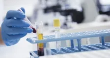 TISSUE TRANSGLUTAMINASE - IGA (TTG)